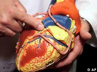 Modelo de corazón: arterias esclerosadas causan infartos.