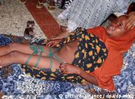 Fay Mohammed lays with her legs bound so that the wound can heal, Mogadishu, Somalia, Monday, 08 March 2004
