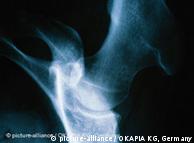 Рентгеновский снимок тазобедренного сустава