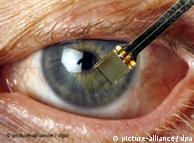 El implante dispone de 1.500 fotocélulas instaladas en un microchip de tan sólo tres milímetros. 