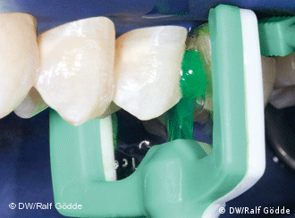 استفاده از ماده‌ای به نام ICON بجای دستگاه تراش دندان 