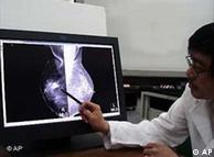 X射线检查只能诊断出一半的早期乳腺癌